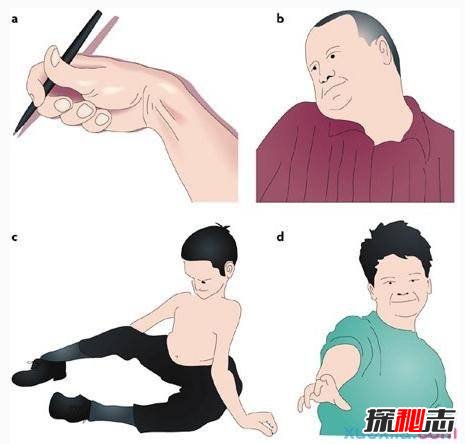 中國世界首例舞蹈豬,亨廷頓氏舞蹈癥是什么??？